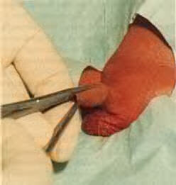 Placement of mosquito clamps for performing circumcision with the Gomco clamp.